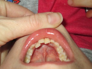 You can see the floor of his mouth being pulled by the frenulum. And his newest shark tooth coming in on the right.