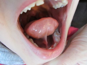 Check out those deep pockets on either side of the frenulum!