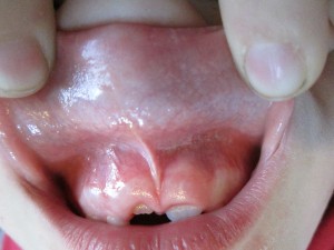 You can see his lip flanges easily over his nose without any blanching. And his frenulum doesn't go all the way down his gums. It's important to remember having a frenulum of the lip or tongue is normal, it's the function that tells us if there is a need for a release. In this case he can eat fine and his speech is perfect. So no impaired function, no red flags for problems with teeth spacing, so no need to release.